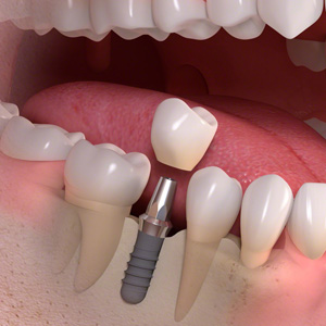1 Implant-borne_single-tooth_treatment_03