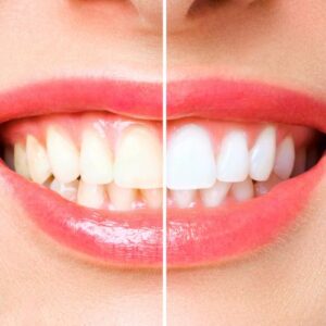 blanqueamiento dental