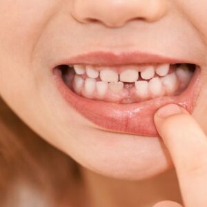 dientes de leche