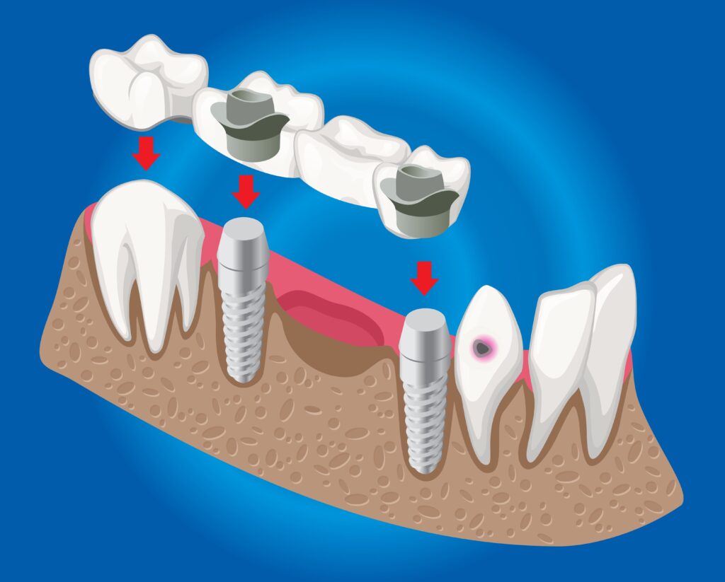 qué es un implante dental