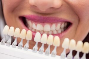 tipos de carillas dentales