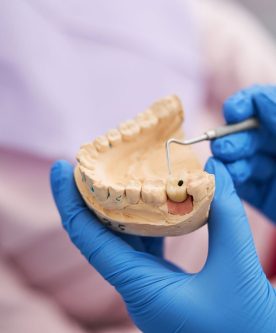 Cómo-sé-si-tengo-una-caries