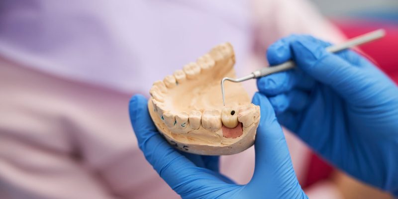Cómo-sé-si-tengo-una-caries