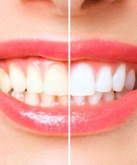 blanqueamiento dental