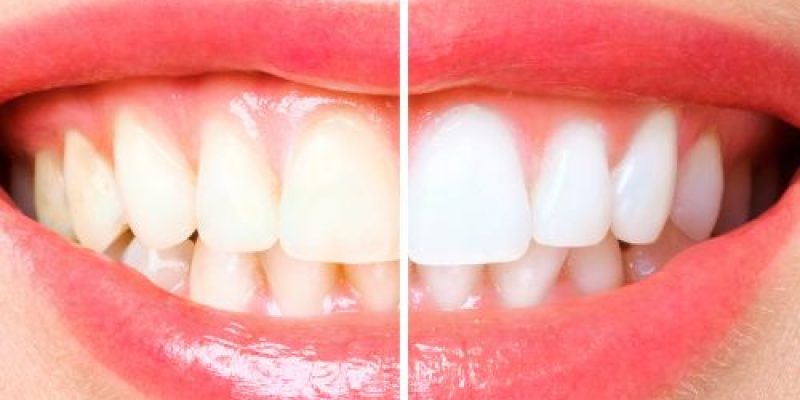 blanqueamiento dental