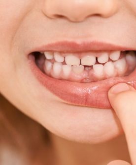 dientes de leche