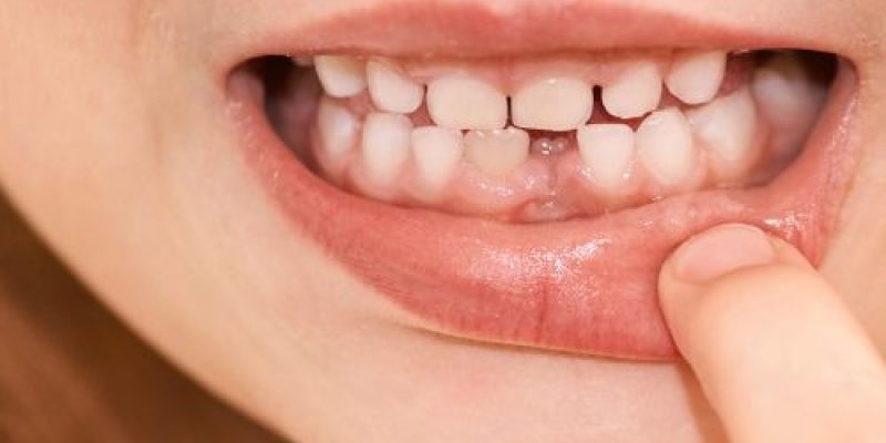 dientes de leche