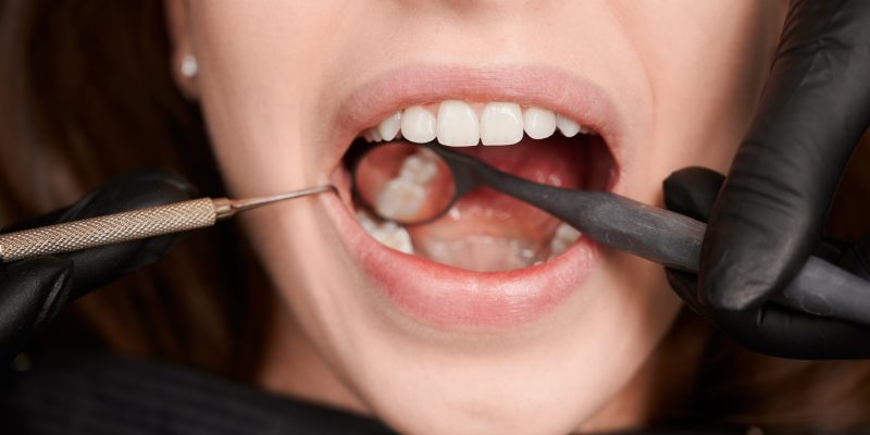 Close-up, cropped snapshot of good looking woman at dentist office during teeth checkup. Dentist examining patient's teeth with mirror and explorer. Oral hygiene concept