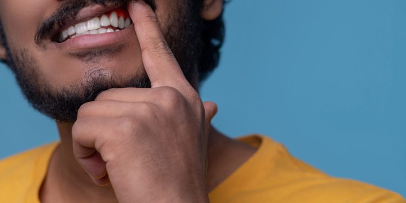 hombre-adulto-mostrando-su-enfermedad-periodontal-ante-la-camara-min hombre-adulto-mostrando-su-enfermedad-periodontal-ante-la-camara-min