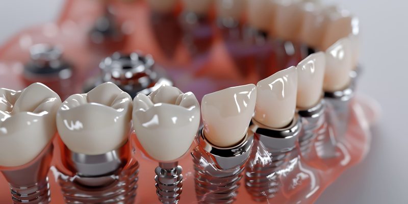 Tipos de implantes dentales